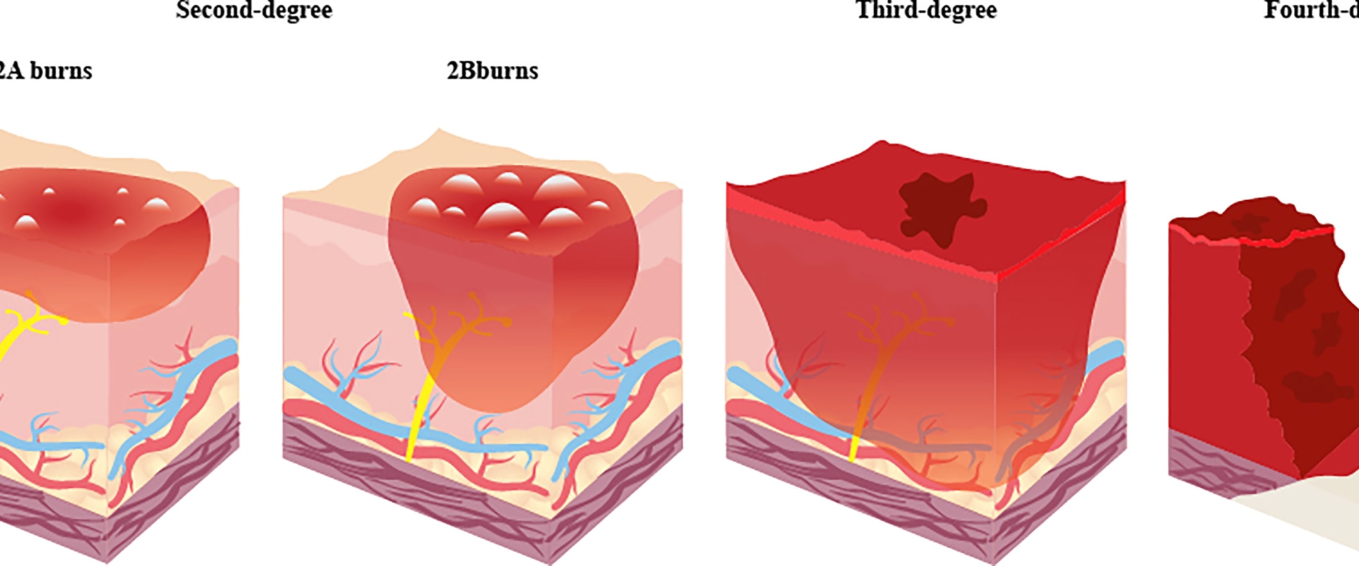 Exploring the Different Stages of Healing 2nd Degree Burns